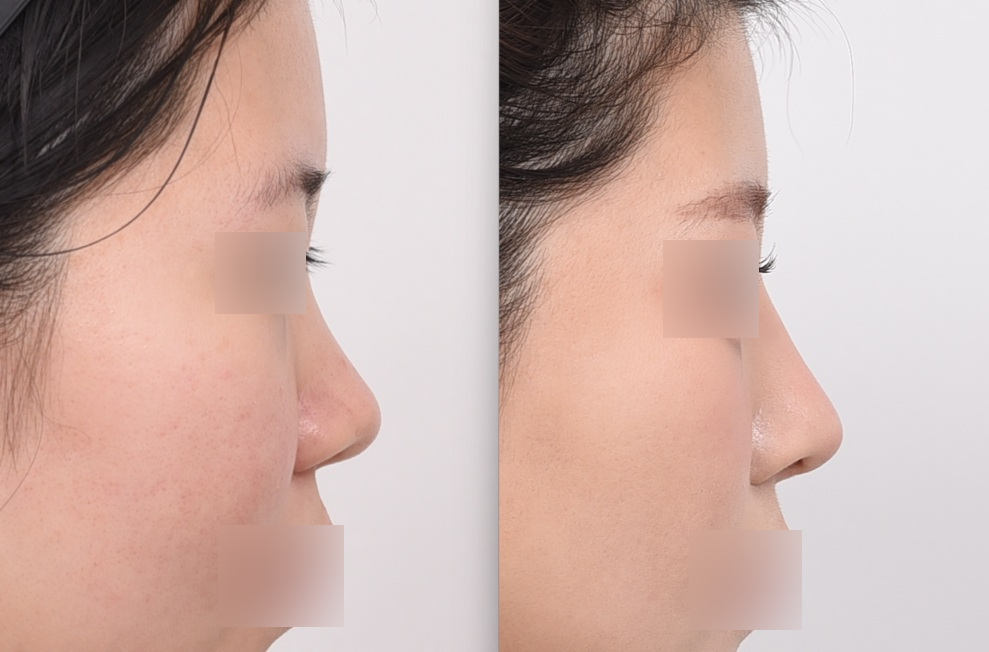 Before and after no-implant rhinoplasty for thick skin using autologous rib cartilage – side view