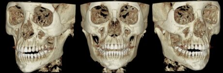Is Revision Jaw Surgery Simply About Removing More Bone?