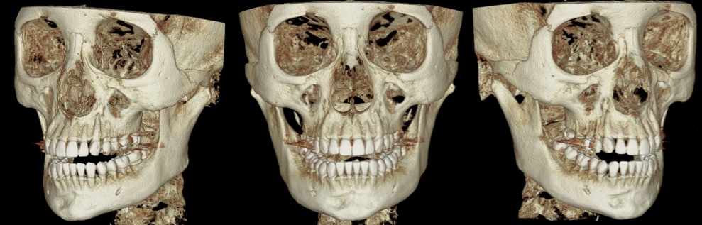 Pre-revision jaw contour CT showing irregular mandibular border and residual cortical bone after previous jaw surgery