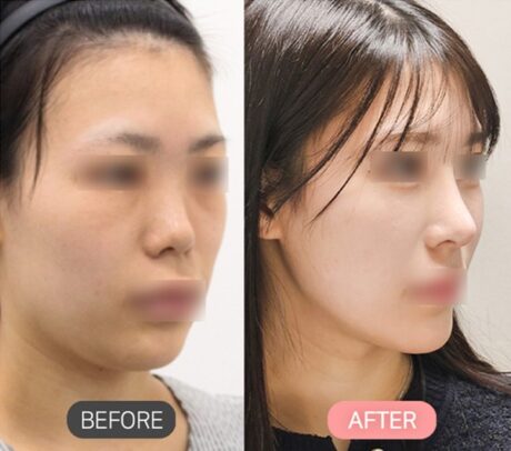Rib Cartilage Rhinoplasty Without Implants: Natural Bridge & Tip Surgery in Korea