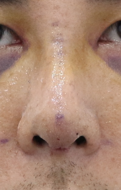 Rhinoplasty swelling 1 week after short nose surgery in a male patient