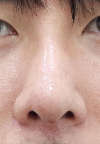 Rhinoplasty swelling 3 months after male short nose surgery – front view