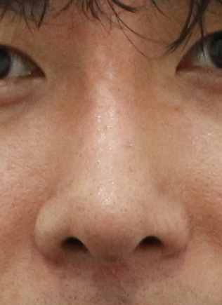 Rhinoplasty swelling 6 months after male short nose surgery – front view