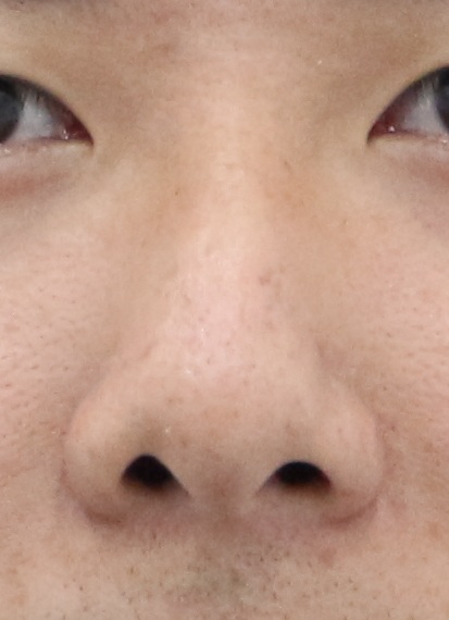 Male short nose before rhinoplasty – front view
