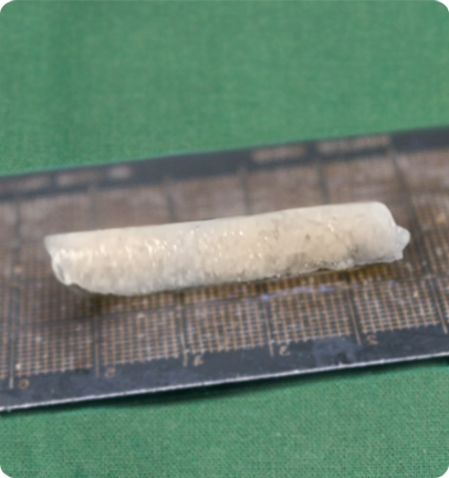 Diced rib cartilage graft molded for dorsal augmentation rhinoplasty