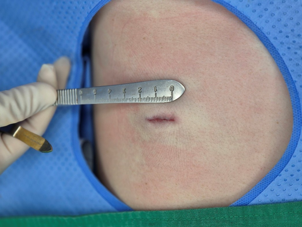 Rib cartilage harvest scar following rhinoplasty