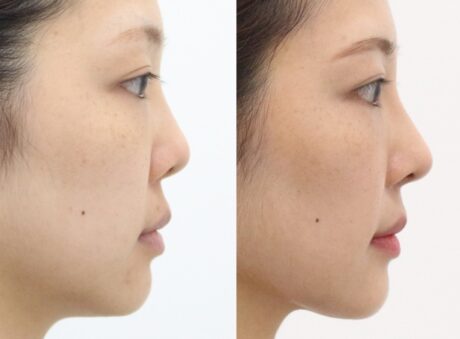 Why Does My Nose Look Upturned After Rhinoplasty?