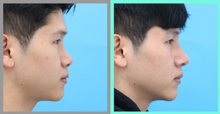 Preoperative and 1-month postoperative photographs after 8 mm customized silicone implant rhinoplasty