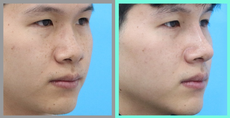 Preoperative and 1-month postoperative photographs after 8 mm customized silicone implant rhinoplasty