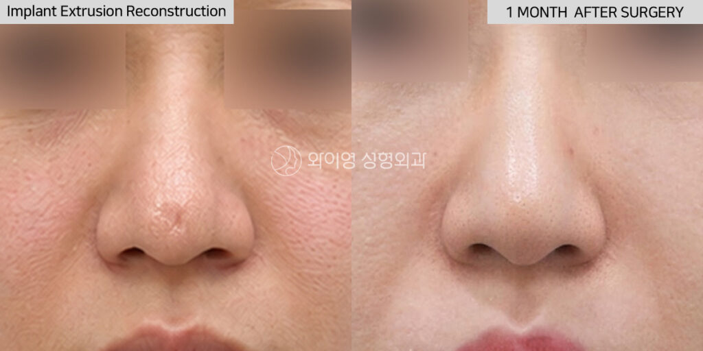 Front view before and after silicone implant extrusion reconstruction using autologous rib cartilage revision rhinoplasty in Gangnam, Seoul, Korea