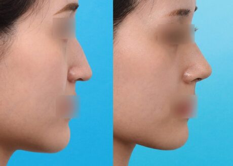 Tip Plasty in Korea: Small Changes, Big Difference