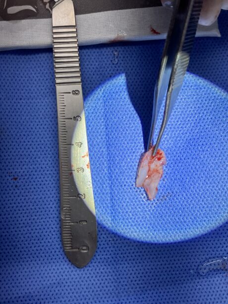 Why Is the Septum Important in Rhinoplasty?