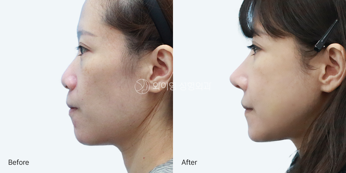 Facial Contouring