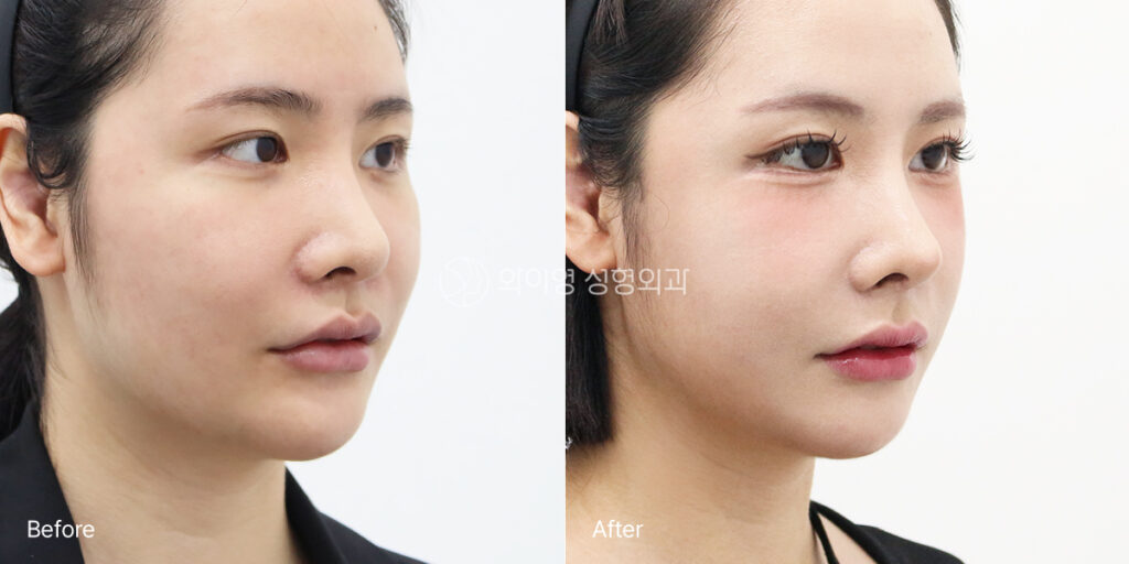 Oblique view before and after revision rhinoplasty for a crooked nose and low nasal tip in Korea