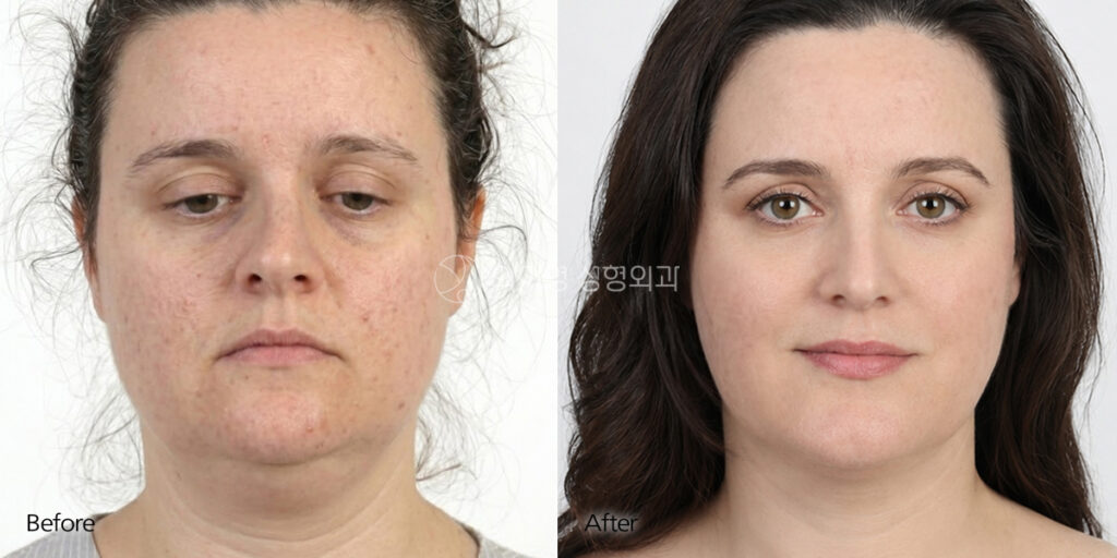 Short Nose Surgery in Korea Before and After – Front View, 5 Months Postoperative