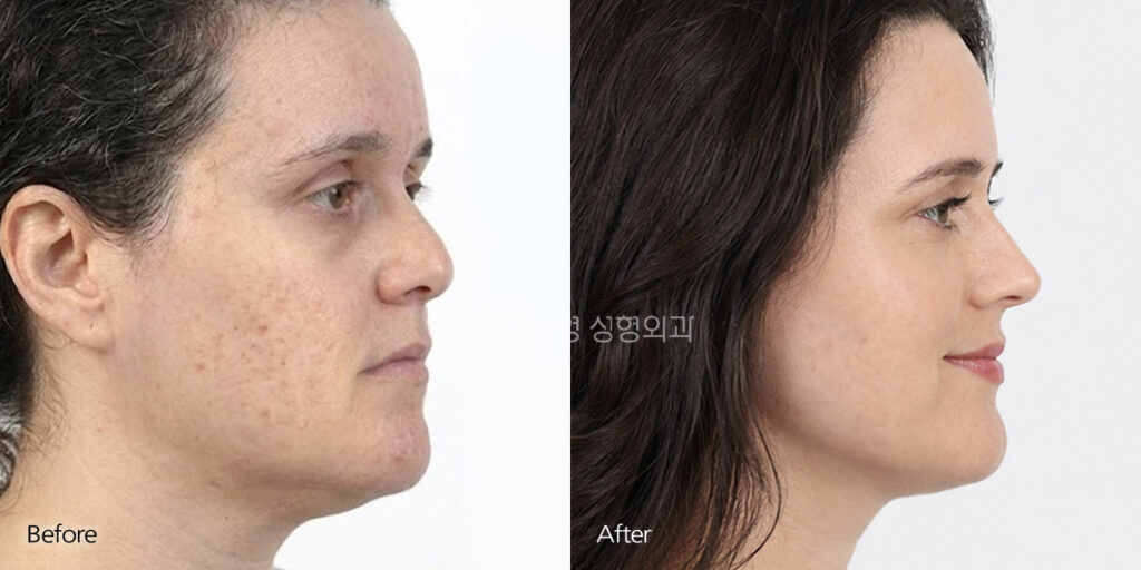 Short Nose Surgery in Korea Before and After – Side Profile, 5 Months Postoperative