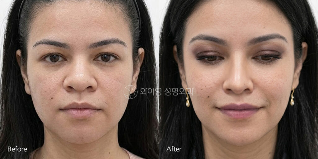 Bulbous Nose Surgery Before and After – Front View, 3 Months Postoperative