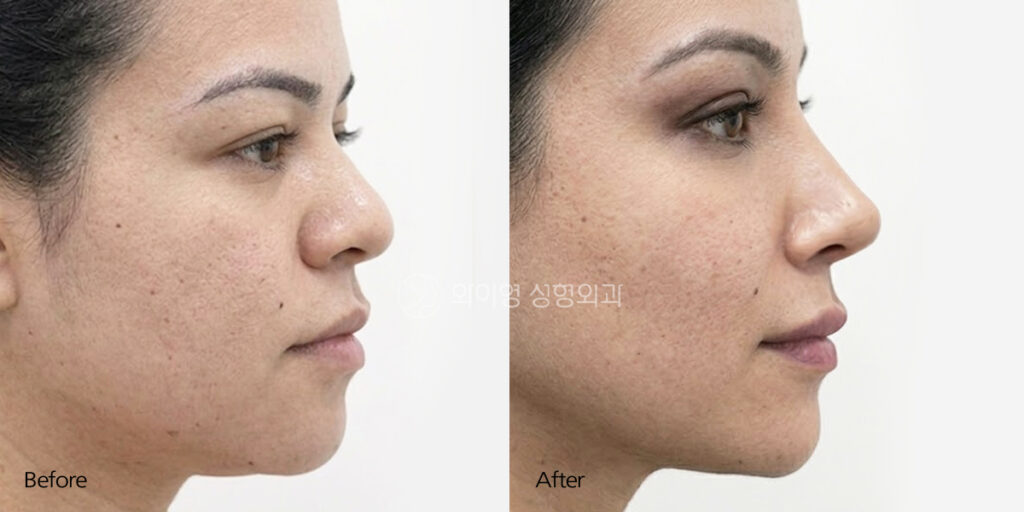 Bulbous Nose Surgery in Korea Before and After – Side Profile, 3 Months Postoperative