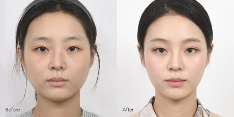 Does Jaw Contouring Cause Sagging?