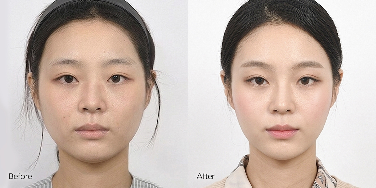 Before and after facial contouring surgery including jaw contouring and zygoma reduction with minimal soft tissue sagging