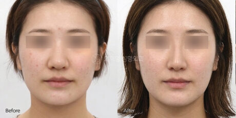 Why Does My Nose Look Wide After Rhinoplasty? | Understanding the Bulbous Nasal Tip and Why Tip Refinement Requires More Than Simply Making the Nose Smaller