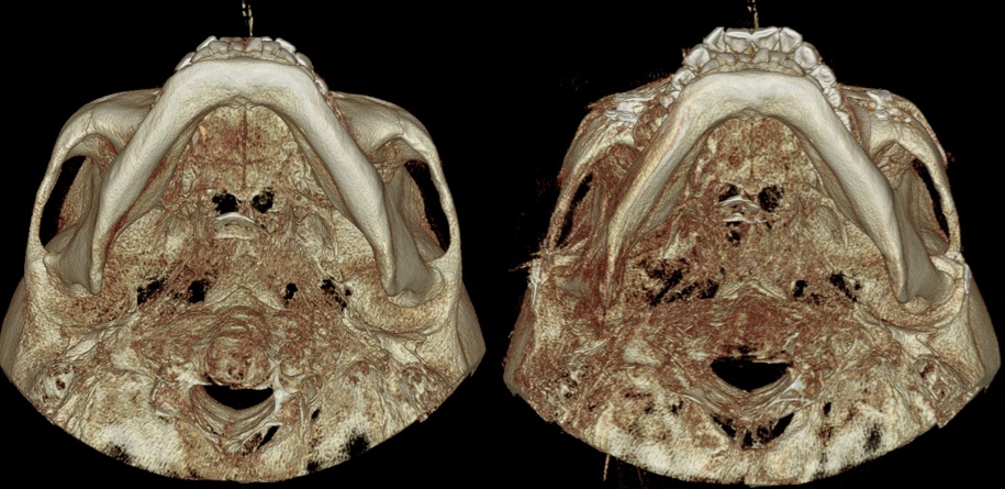 Preoperative and postoperative zygoma CT showing inward repositioning of the zygomatic arch and improved facial width reduction