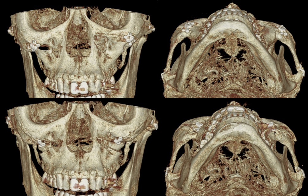 3D-CT images of revision cheekbone reduction surgery with a newly designed medial osteotomy line