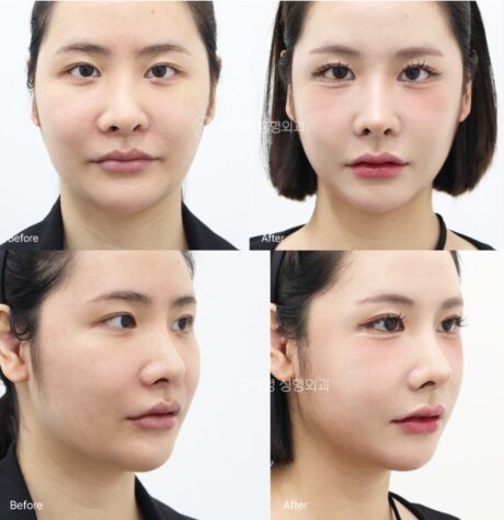 Is Zygoma Reduction Surgery Simply About “Reducing the Cheekbones”?