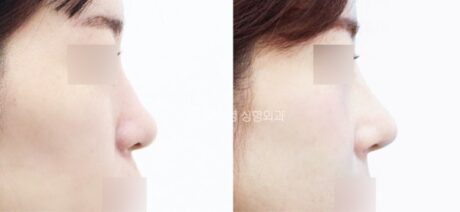 Why Do Some Rhinoplasty Results Look Unnatural?