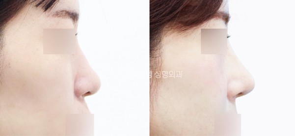 Before and after rhinoplasty with nasolabial angle correction and tip projection enhancement