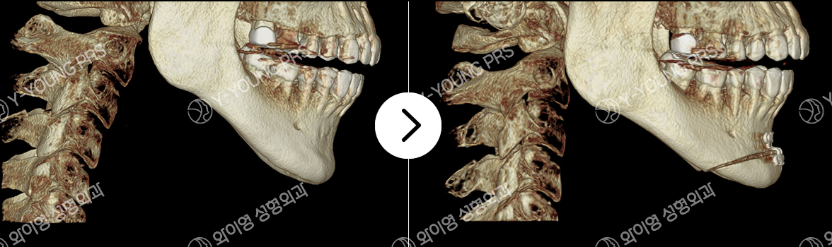 Preoperative and postoperative CT showing advancement genioplasty with stable fixation