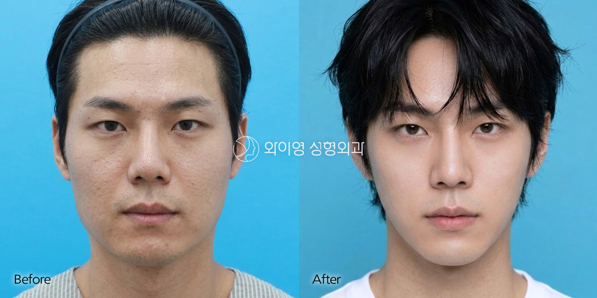 Male facial contouring before and after front view – cheekbone, jaw and chin surgery