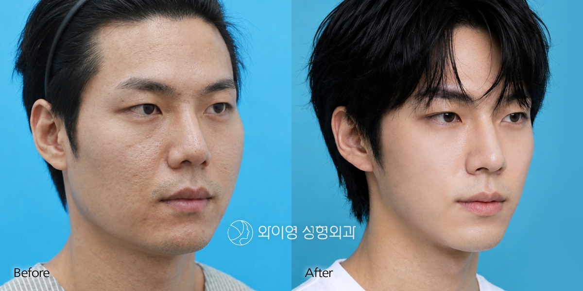 Male facial contouring before and after 45-degree view – cheekbone and jawline reduction