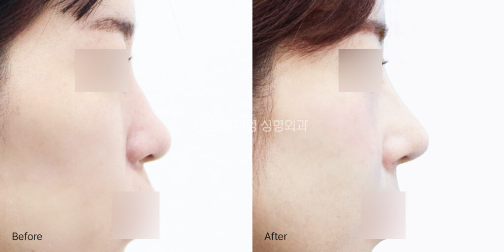 Implant-free rhinoplasty before and after side view showing correction of a bulbous nasal tip with a more refined and naturally defined profile