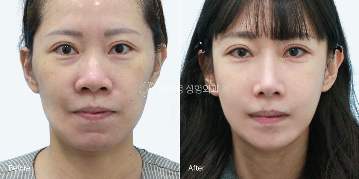 Front-view before and after facial contouring and rhinoplasty for a low, bulbous, and wide nose, showing improved facial shape and nasal definition.