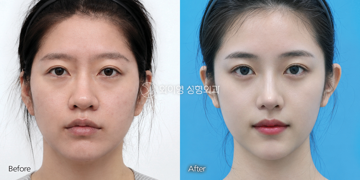 1-month result after hump nose correction without a nasal implant.