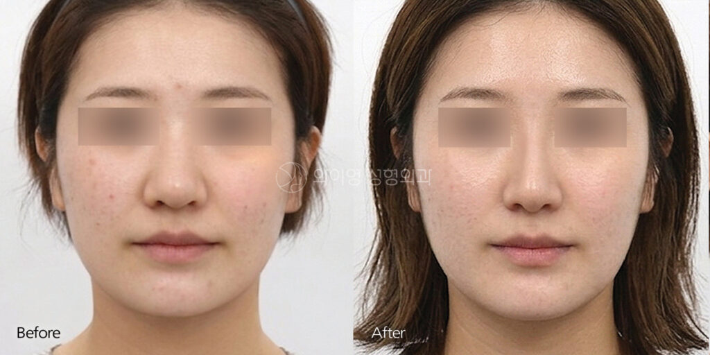Bulbous nose rhinoplasty before and after showing a slimmer, more defined nasal tip from the front view
