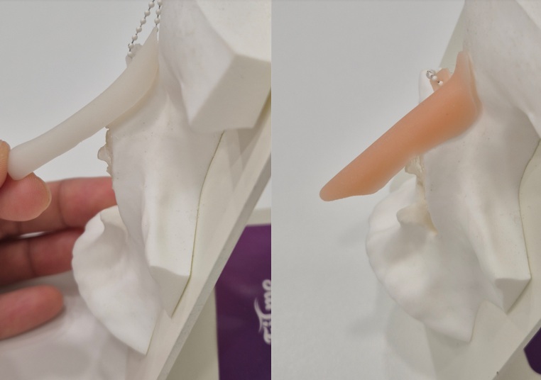 Comparison demonstrating the anatomical fit of a 3D customized silicone implant on the nasal framework