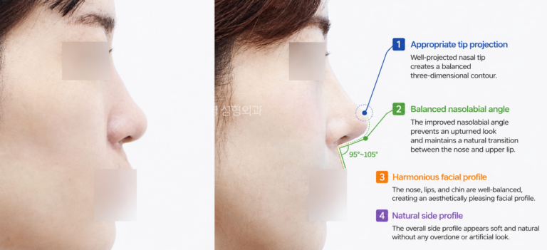 Natural rhinoplasty with balanced nasolabial angle correction and appropriate tip projection